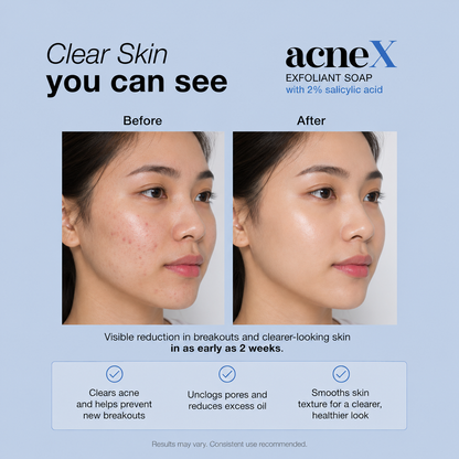 AcneX Exfoliant Soap