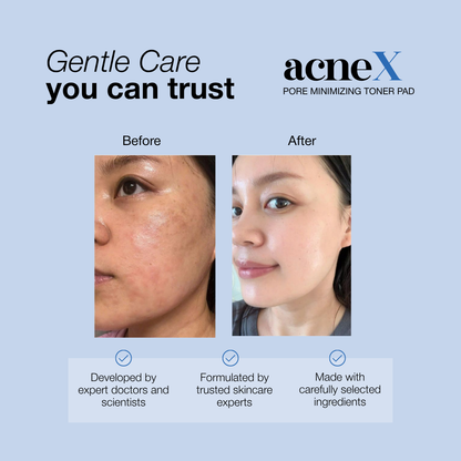 AcneX Toner Pads