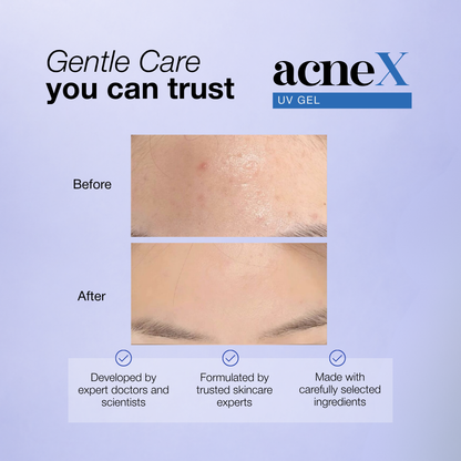 Acne X UV Gel Water-Based Sunscreen SPF 30+ PA+++